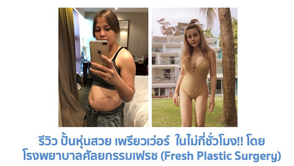รีวิว ปั้นหุ่นสวย เพรียวเว่อร์ ในไม่กี่ชั่วโมง!! โดย โรงพยาบาลศัลยกรรมเฟรช (Fresh Plastic Surgery) (ตอนที่ 1)