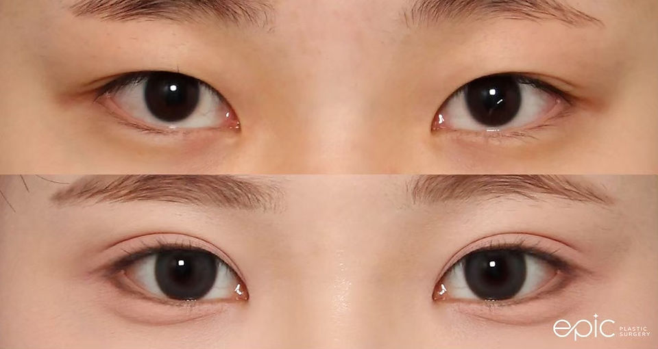 รีวิวศัลยกรรมตา รพ.อีพิก Epic หมอโน ยองจุน