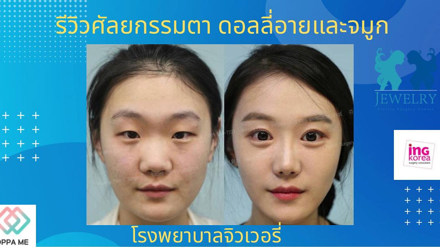 รีวิวศัลยกรรมตา&ดอลลี่อาย &เสริมจมูก รพ.จิวเวลรี่ (ตอนที่ 2)