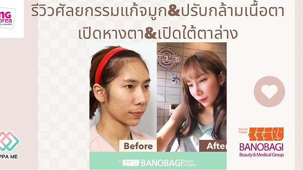 รีวิวแก้จมูก ปรับกล้ามเนื้อตา เปิดหางตา เปิดใต้ตาล่าง โรงพยาบาลบาโนบากิ (ตอนที่ 1)