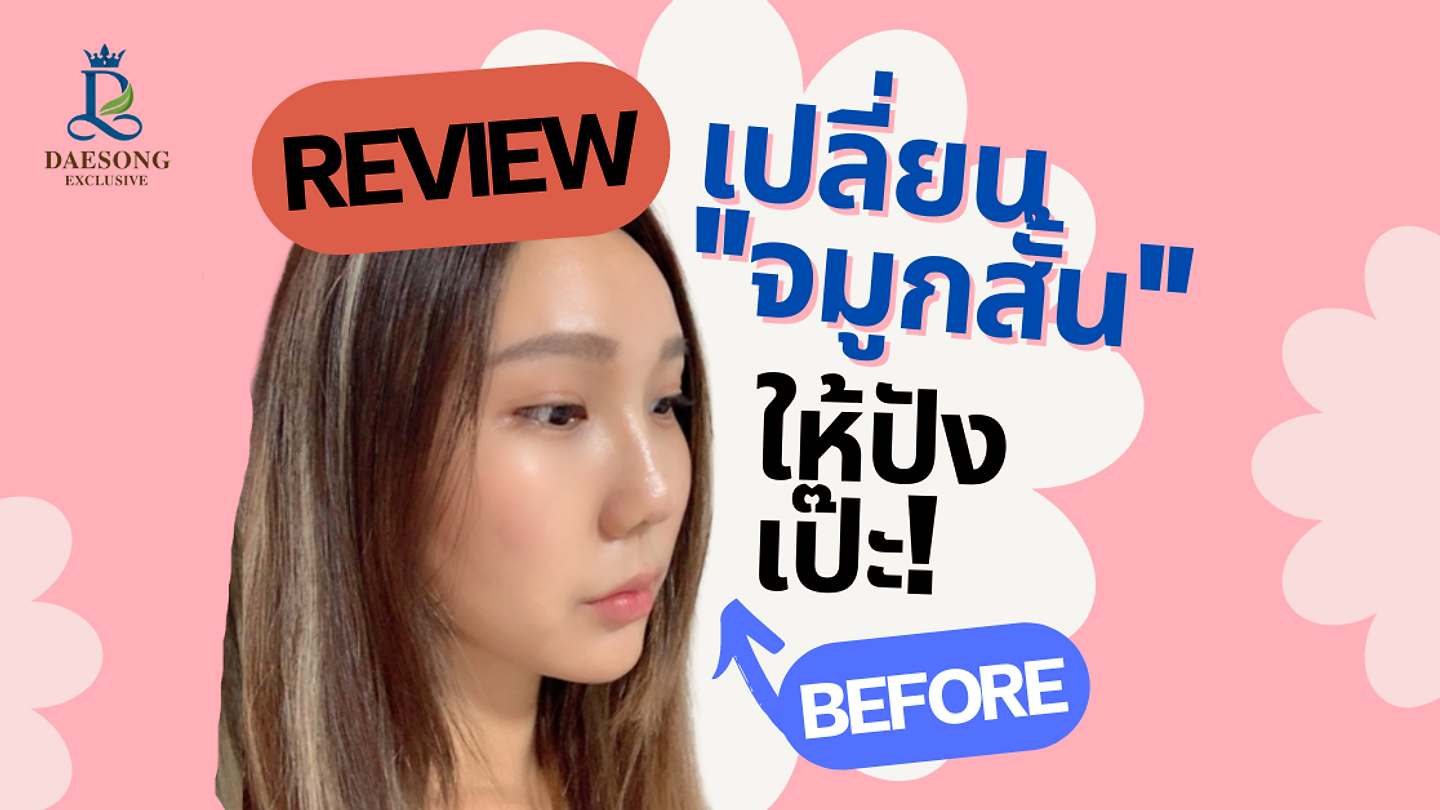รีวิวเสริมจมูก ฉบับสาวจมูกสั้น บาโนบากิ (ตอนที่ 2)