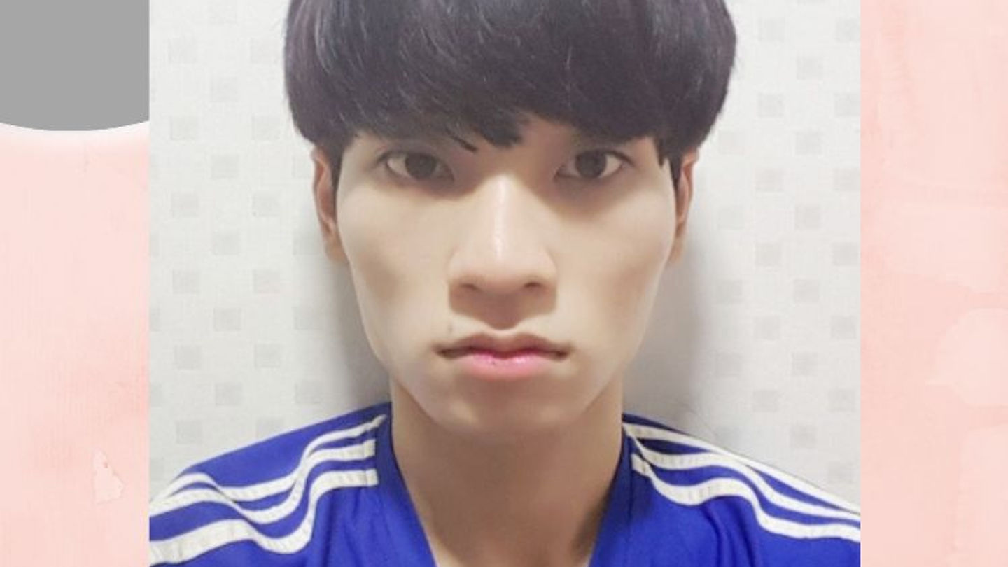 รีวิว ศัลยกรรมโครงหน้า เพิ่มความละมุน รพ.นานะ (ตอนที่ 2)