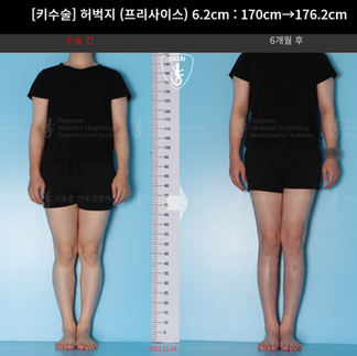 รีวิวผ่าตัดเพิ่มความสูง