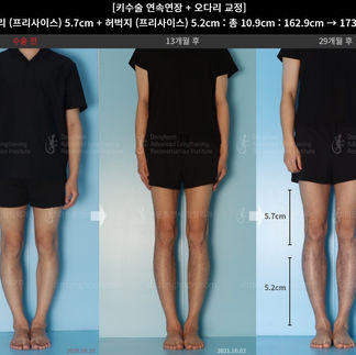 รีวิวผ่าตัดเพิ่มความสูง