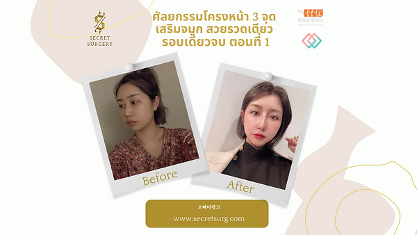 ศัลยกรรมโครงหน้า3จุด เสริมจมูก สวยรวดเดียว รอบเดียวจบ ตอนที่ 1