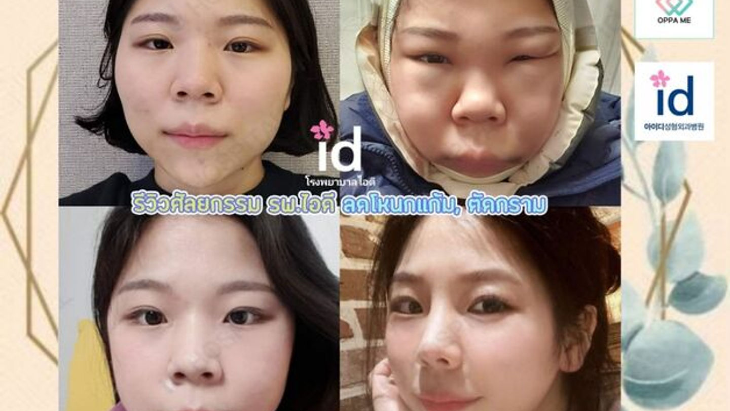 REAL REVIEW ศัลยกรรมโครงหน้า สวยเป็นคนละคนเลยค่าา😍 (ตอนที่ 2)