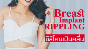 ‘Rippling’ ซิลิโคนเสริมหน้าอกเป็นคลื่น