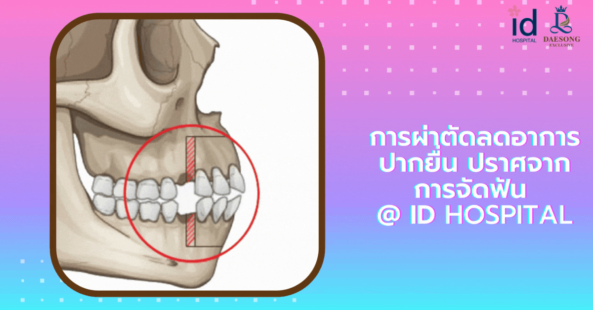ผ่าตัดลดอาการปากยื่น ไม่จำเป็นต้องทำการจัดฟันที่ ID Hospital