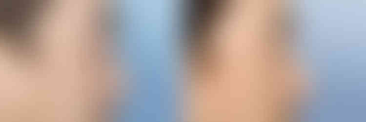 รีวิวเสริมจมูก แก้จมูกผู้ชาย โรงพยาบาลศัลยกรรมเอดิชั่น (Edition Plastic Surgery)