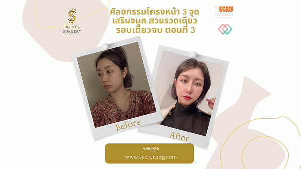 ศัลยกรรมโครงหน้า3จุด เสริมจมูก สวยรวดเดียว รอบเดียวจบ ตอนที่ 3
