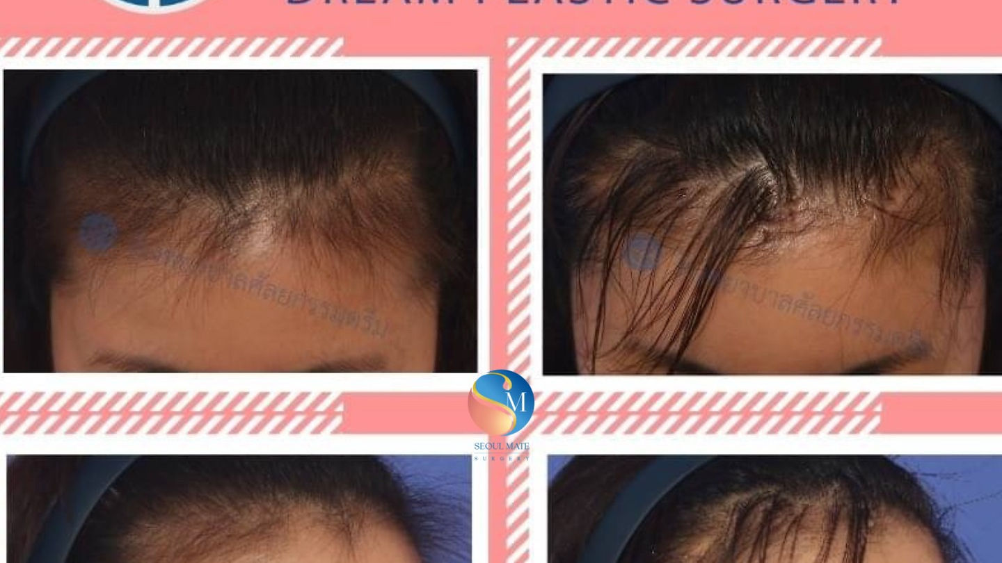 รีวิวแผลจากการทำเอนโดไทม์หลังจากผ่าตัด 7 วันค่ะ (ตอนที่ 1)