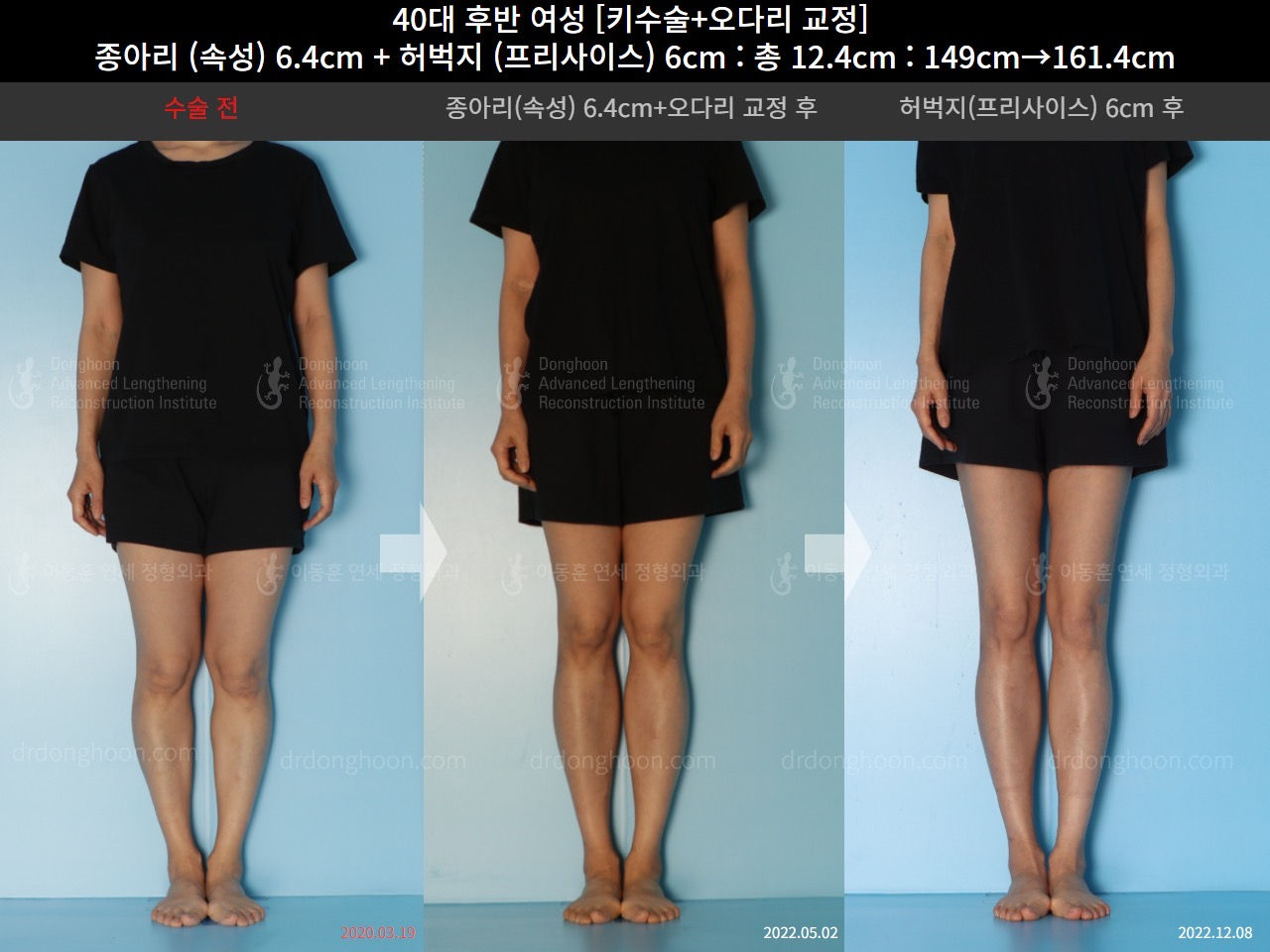 รีวิวผ่าตัดเพิ่มส่วนสูง ที่เกาหลี