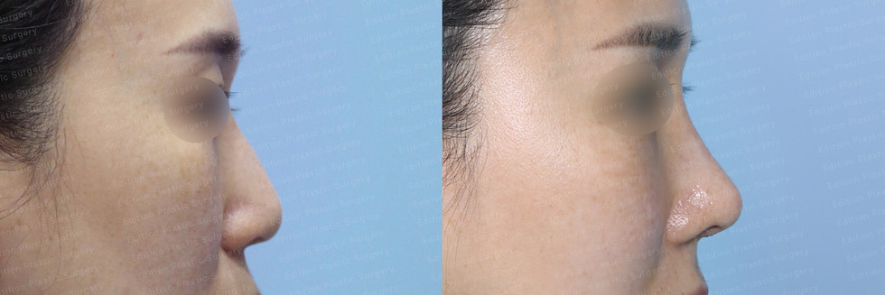 รีวิวเสริมจมูก แก้จมูก โรงพยาบาลศัลยกรรมเอดิชั่น (Edition Plastic Surgery)