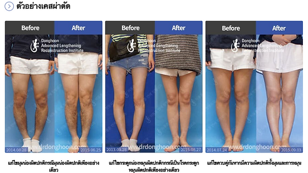 การศัลยกรรมแก้ไขขาโก่ง พักฟื้นเพียง 4-6 สัปดาห์ กับหมอระดับโลก