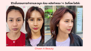 คลิปรีวิวขั้นตอนการทำตาและจมูกตั้งแต่ก่อนทำจนหลังทำครบ 14 วันที่รพ.ไอดีค่ะ
