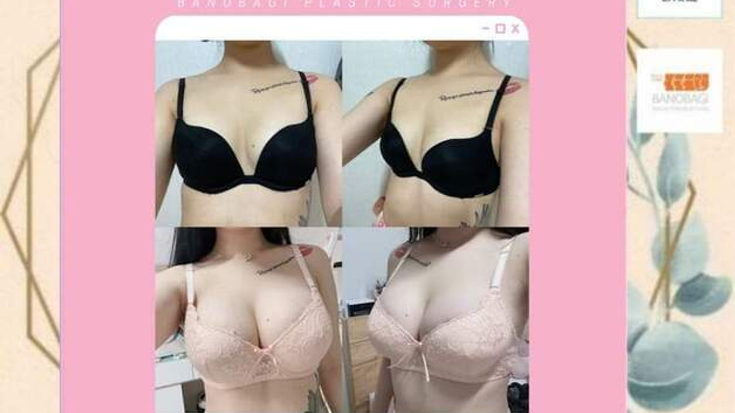 Real Review ศัลยกรรมหน้าอก 🌸MOTIVA x BANOBAGI🌸 (ตอนที่ 2)