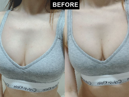 รีวิว เสริมหน้าอก วอลลุ่มหายหลังจากการไดเอท