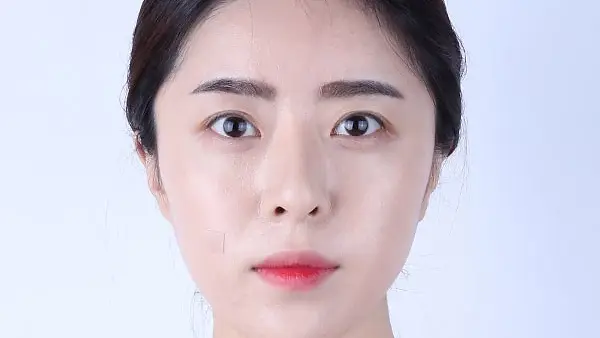 รีวิวปรับโครงหน้า กำจัดไขมันใต้ตา และดูดไขมัน (เหนียง) (ตอนที่ 3)