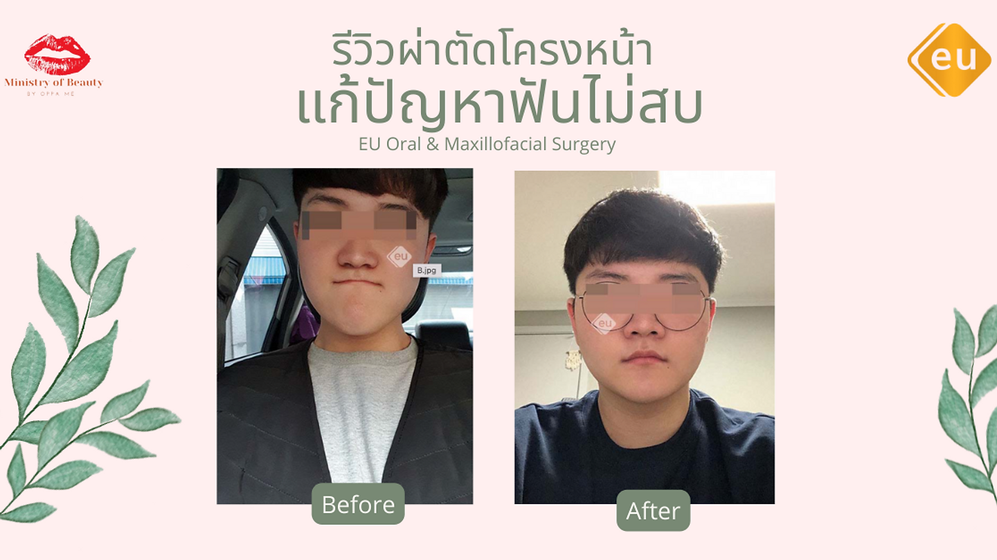 รีวิวผ่าตัดโครงหน้า แก้ปัญหาฟันไม่สบที่ EU (ตอนที่ 1)