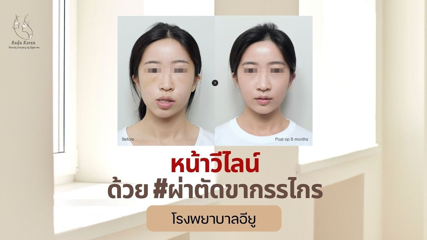 หน้าวีไลน์ด้วย #ศัลยกรรมขากรรไกร ที่โรงพยาบาลอียู