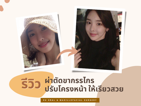 รีวิวปรับโครงหน้า+ขากรรไกรให้เรียวสวย