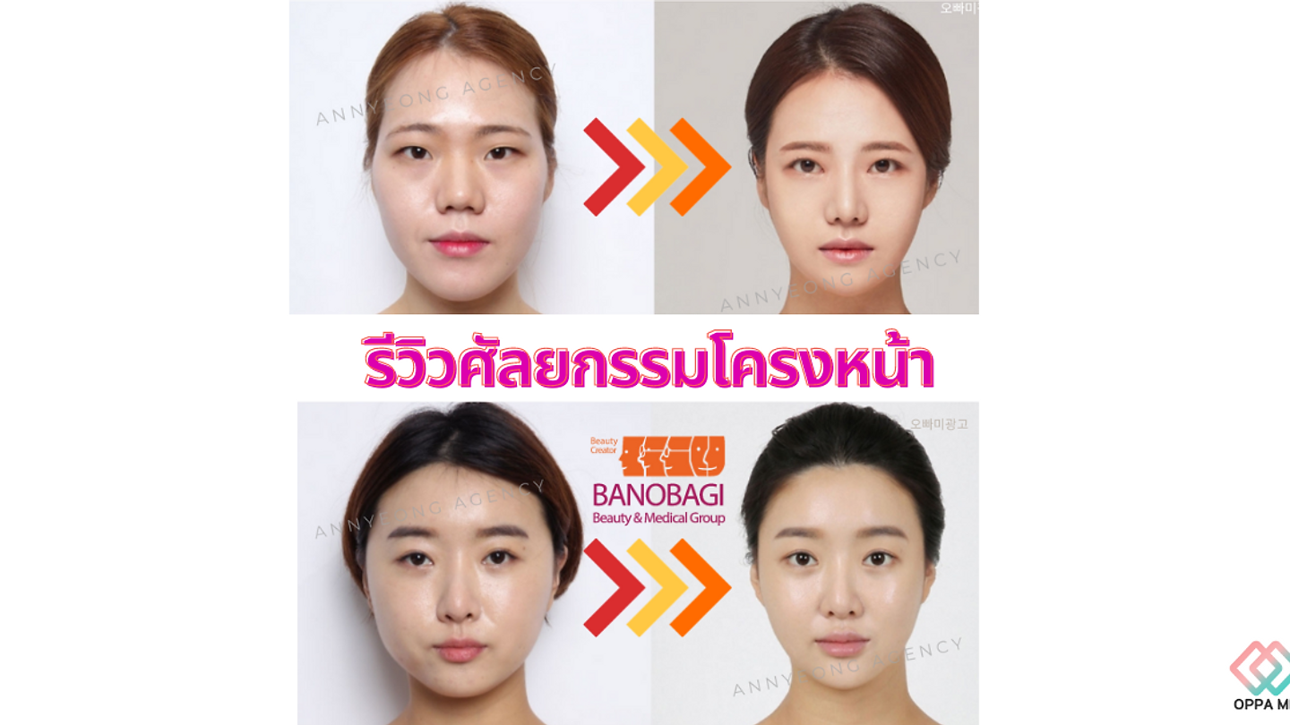 รีวิวศัลยกรรมโครงหน้า กับคุณหมอโอชางฮยอน (ตอนที่ 1)