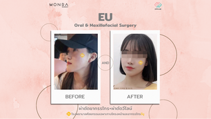 รีวิว ศัลยกรรมขากรรไกร + วีไลน์ รพ.อียู (EU Oral & Maxillofacial Surgery) โดย นุ๊ก Monra Surger