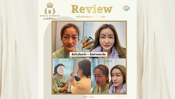 รีวิว ยอดฮิตที่สุดในเกาหลี !!! ฉีดไขมันหน้าเด็ก + ฉีดปากกระจับ