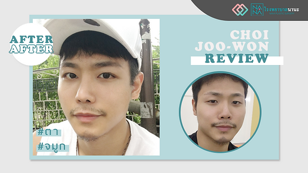 รีวิวศัลยกรรมตา และจมูก ให้รับกับใบหน้า คุณชเวจูวอน (ตอนที่ 1)
