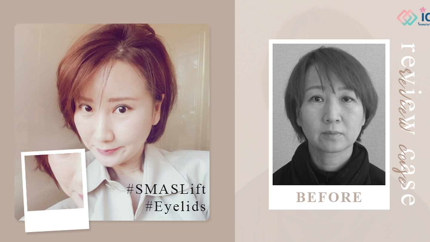 รีวิวยกกระชับ SMASlift เกลี่ยไขมันใต้ตา คืนความอ่อนเยาว์อีกครั้ง (ตอนที่ 1)