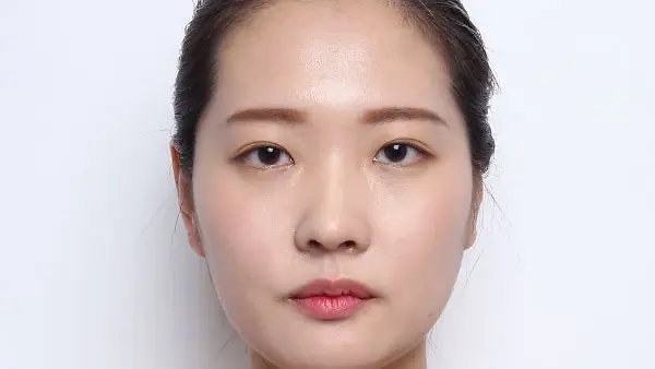 Real Story คุณอูจูรี ปรับโครงหน้า 3 จุด (โหนกแก้ม, กราม, คาง)