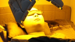 ผิวแก้มหย่อนคล้อย หลังลดโหนกแก้ม