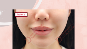 รีวิวศัลยกรรมปากเพิ่มเสน่ห์ โรงพยาบาลดีเซ่