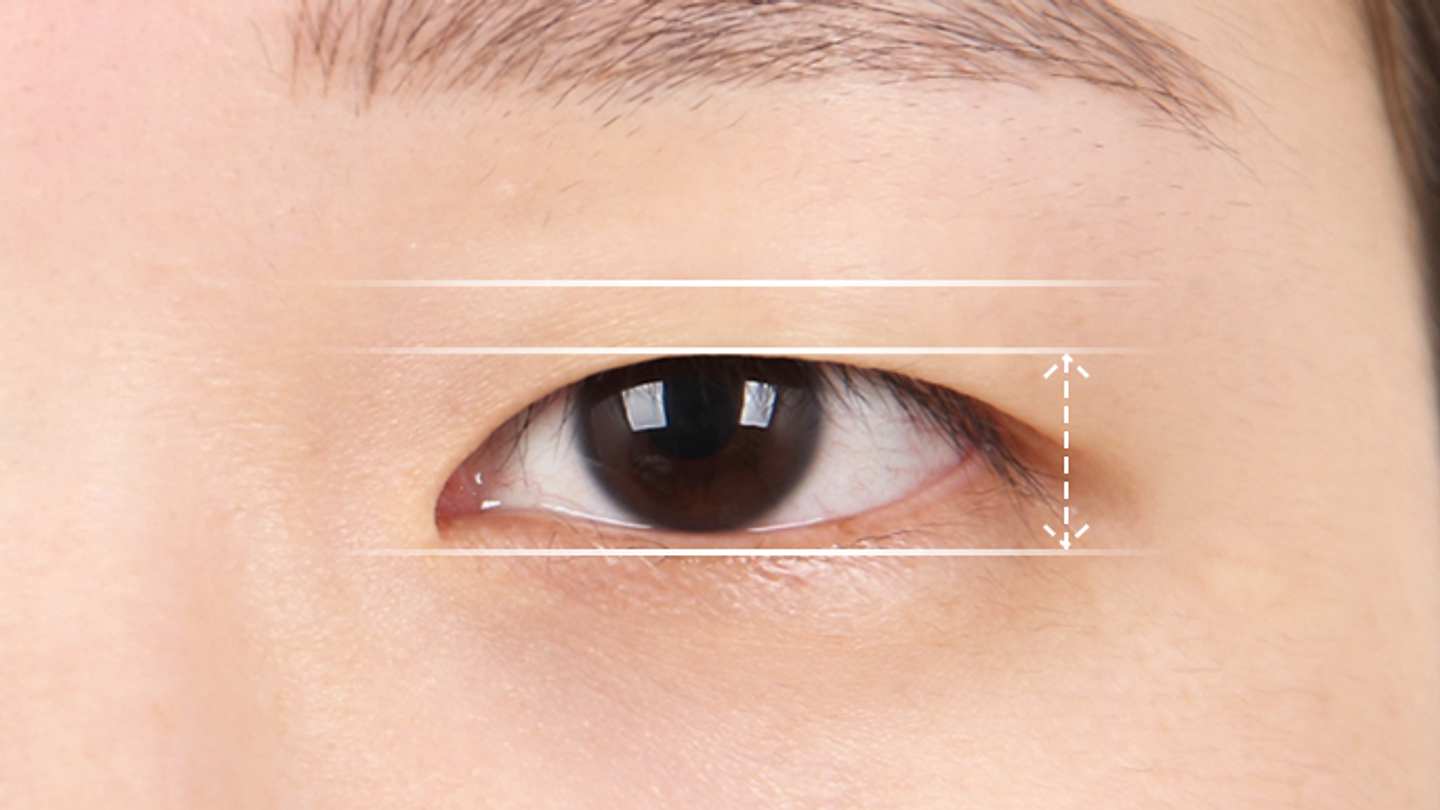 แก้ต้นตอตาตกด้วยศัลยกรรมจาก VIEW