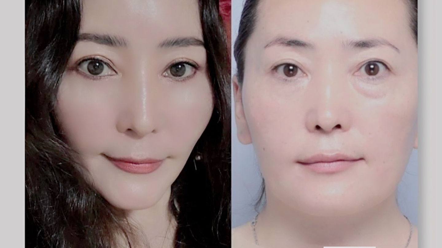 การฉีดไขมันให้ได้ผล ต้องทำยังไง?