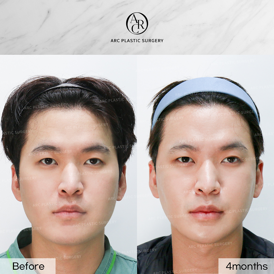 รีวิวศัลยกรรมผู้ชาย > โรงพยาบาลอาร์ค (ARC Plastic Surgery)