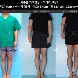 รีวิวผ่าตัดเพิ่มความสูง