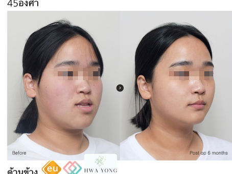 ผ่าตัดขากรรไกร โครงหน้า3จุด