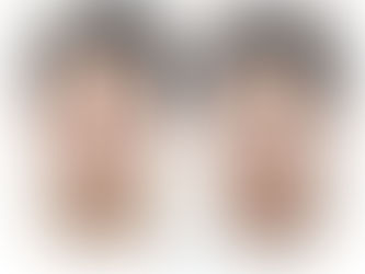 ศัลยกรรมปรับโครงหน้าผู้ชายที่ Note เท่านั้น