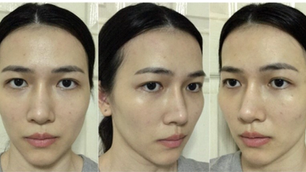 รีวิว แก้จมูกเบี้ยว ตาเศร้า โครงหน้าไม่เท่ากัน