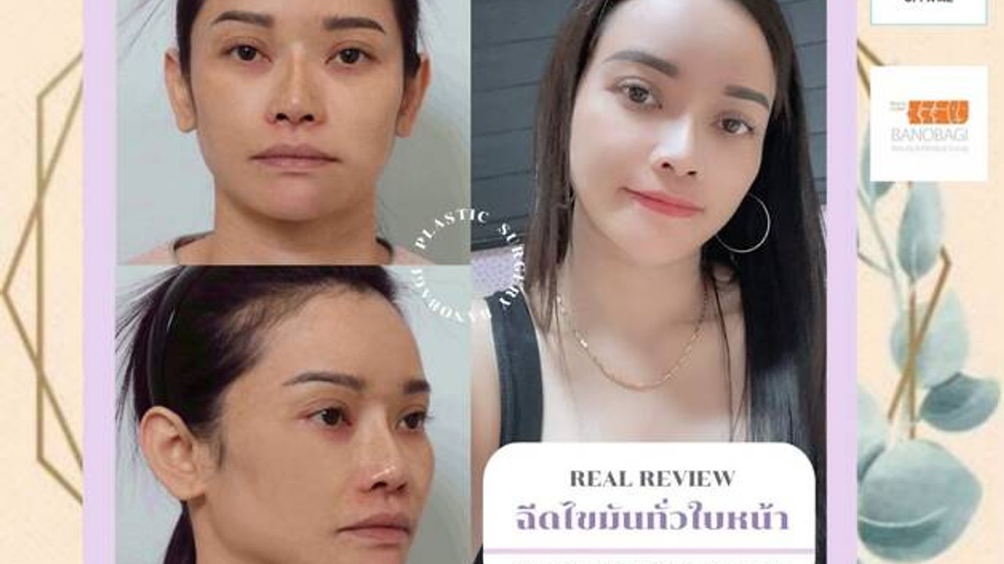 🧡REAL REVIEW ฉีดไขมันหน้าเด็ก🧡 (ตอนที่ 2)