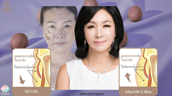 ยกกระชับหน้าด้วยไหมอิลาสติคกุม+ดูดไขมันหน้า (ตอนที่ 1)