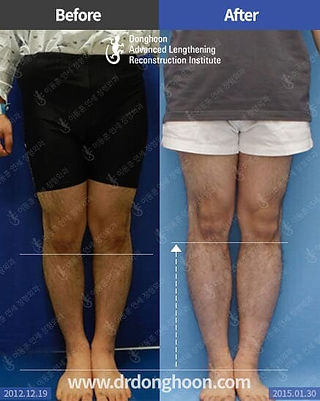 ศัลยกรรม เพิ่มความสูง