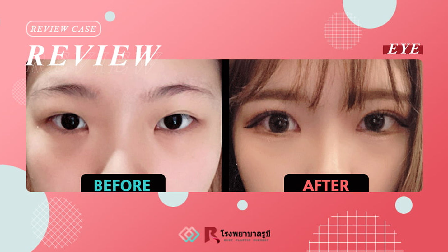 รีวิวทำตาสองชั้น วิธีกรีด แก้ไขตาตก และเปิดหัวตา + เปิดหางตา (ตอนที่ 2)