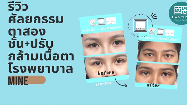 ทำไมถึงต้องปรับกล้ามเนื้อตา ควบคู่ไปกับผ่าตัดตา2ชั้น (ตอนที่ 1)