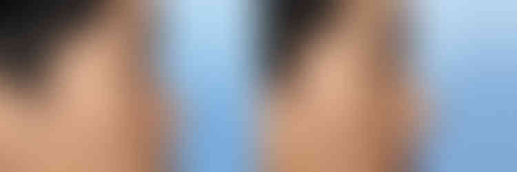 รีวิวเสริมจมูก แก้จมูกผู้ชาย โรงพยาบาลศัลยกรรมเอดิชั่น (Edition Plastic Surgery)