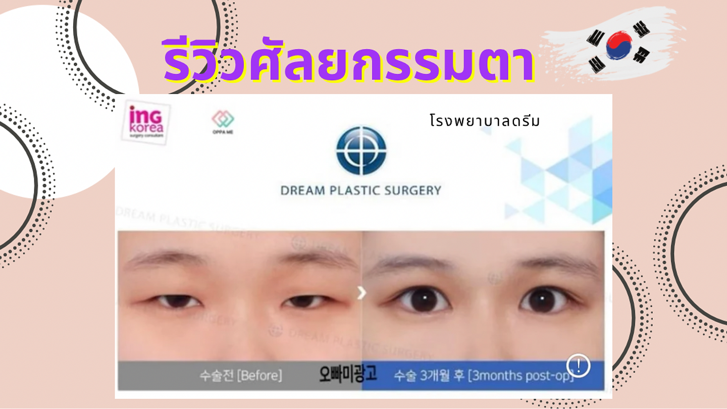 รีวิวศัลยกรรมตา โรงพยาบาลดรีม (ตอนที่ 1)