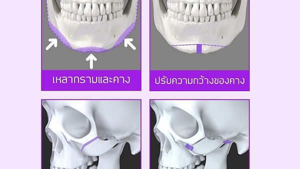 โครงหน้า V Line คืออะไร