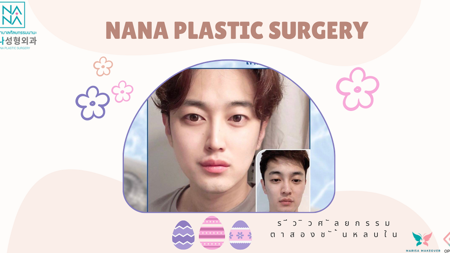 รีวิวศัลยกรรมตาสองชั้นแบบหลบใน (ตอนที่ 2)