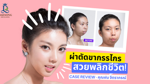 ผ่าตัดขากรรไกรพลิกชีวิต! คุณฝน จิตราภรณ์ – By Banobagi